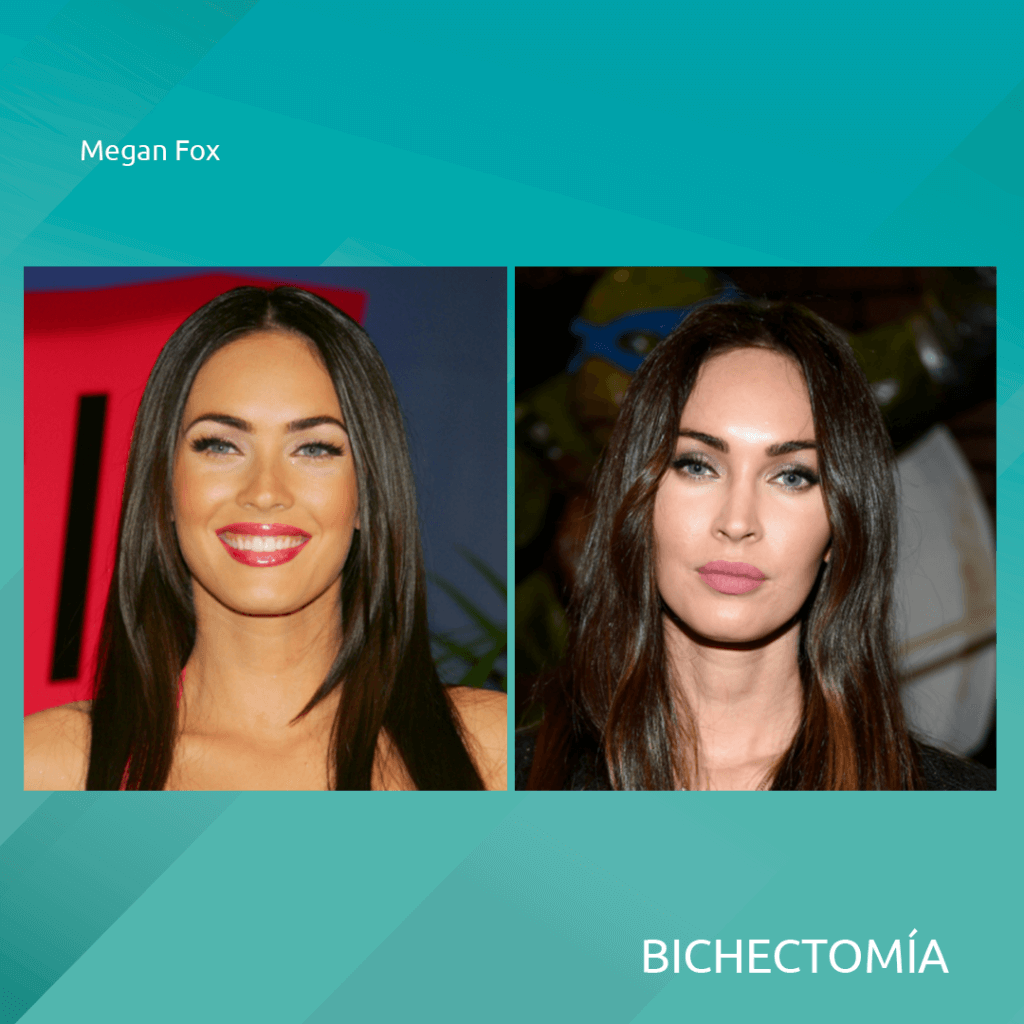famosas celebridades con bichectomia cirugia alargamiento y adelgazamiento del rostro 3