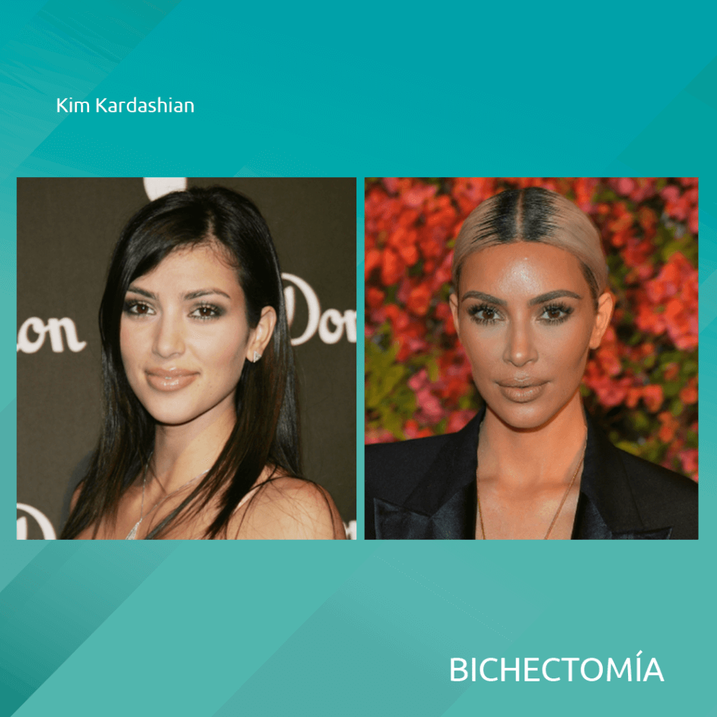 famosas celebridades con bichectomia cirugia alargamiento y adelgazamiento del rostro 4