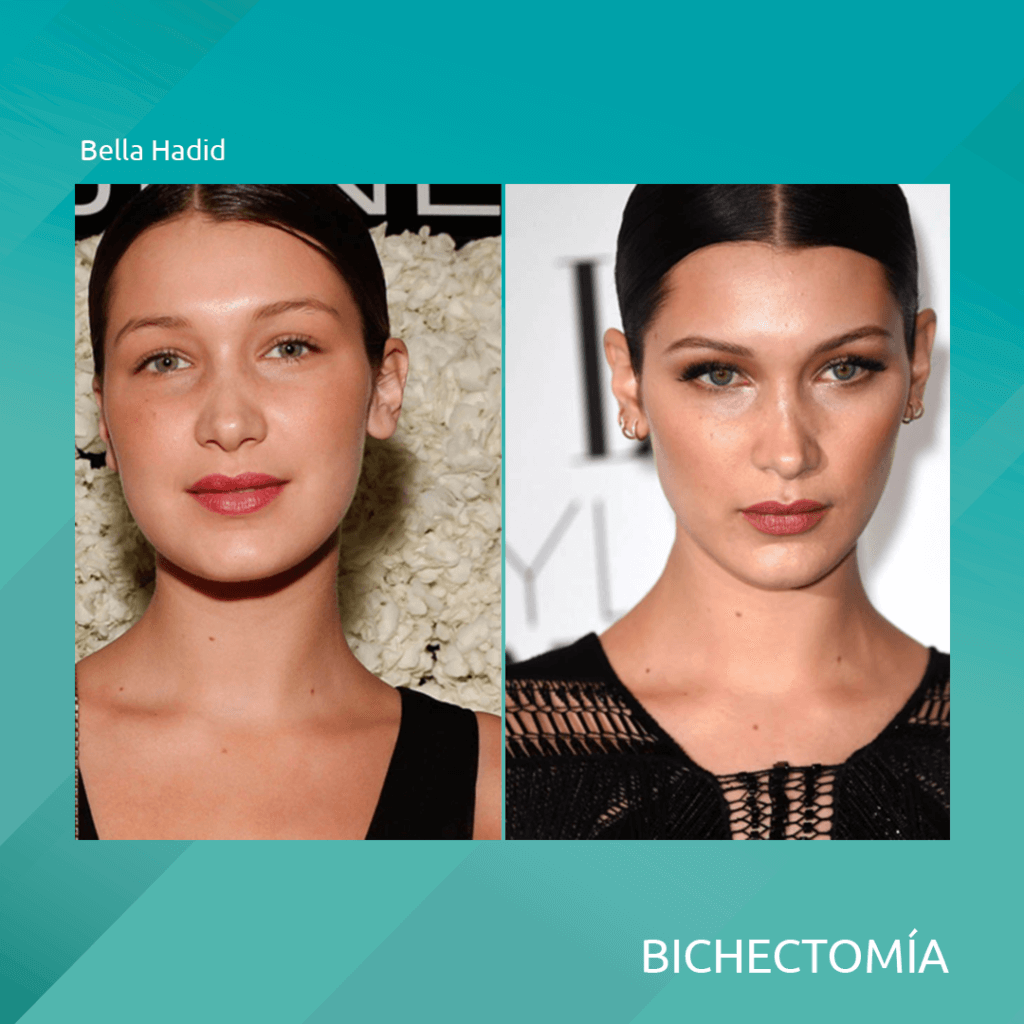 famosas celebridades con bichectomia cirugia alargamiento y adelgazamiento del rostro 1