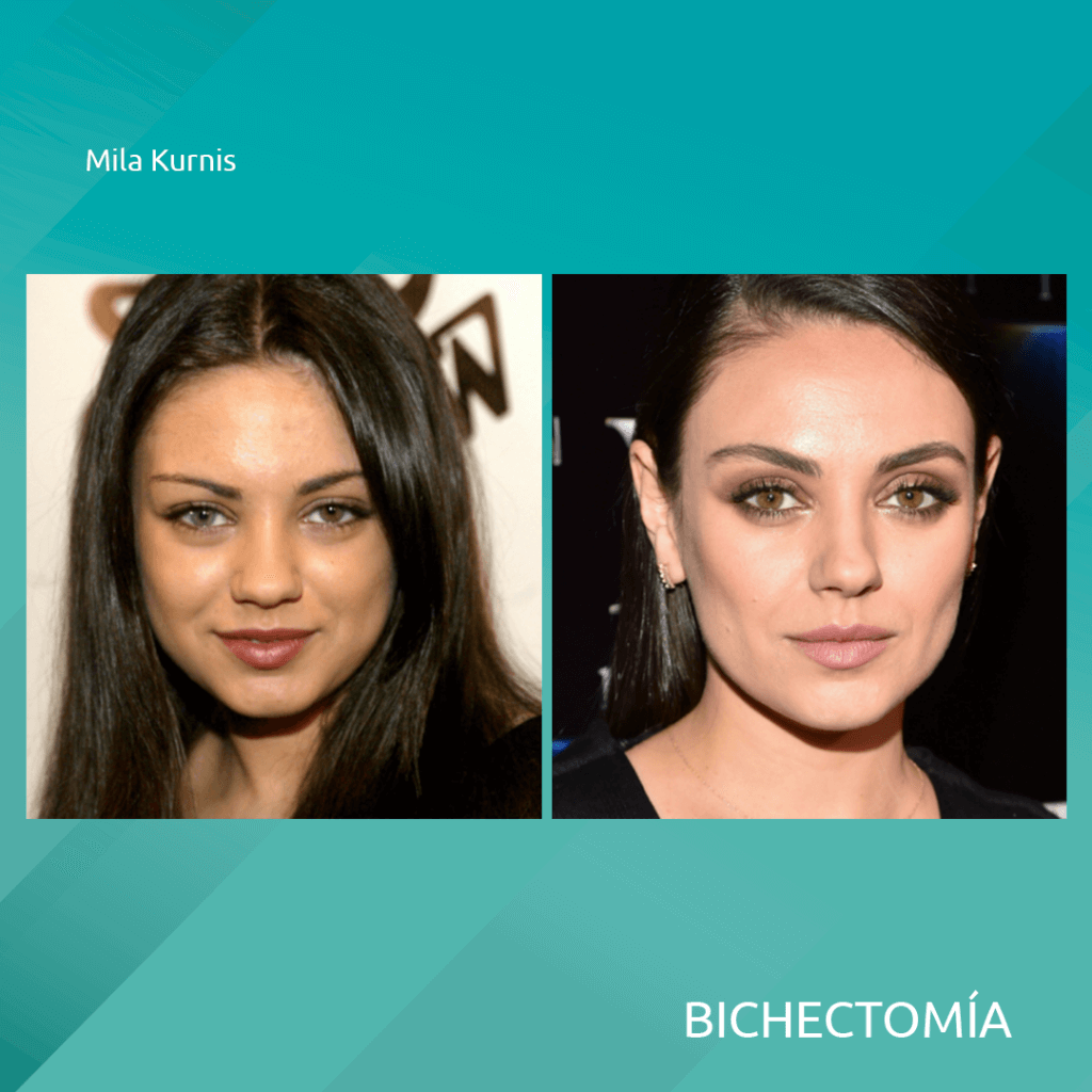 famosas celebridades con bichectomia cirugia alargamiento y adelgazamiento del rostro 2 1