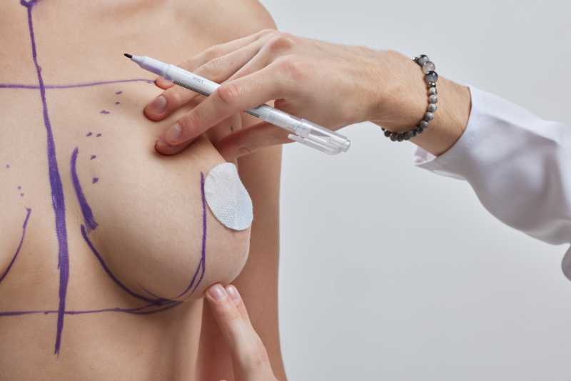 Tipos de implantes mamarios