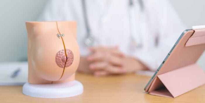 Cuidados postoperatorios para mamas con expansor mamario