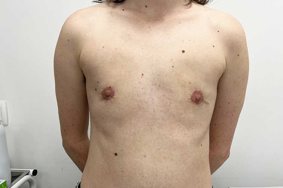 Resultado despues mastectomia