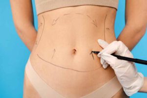 Diferencia entre la abdominoplastia y la liposucción