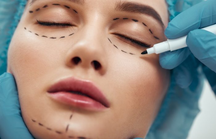 El cirujano estético traza líneas sobre la piel de los párpados de una paciente joven antes de realizar una blefaroplastia en el quirófano.