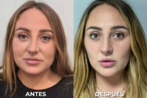 Famosas con bichectomía: Rocío Flores, antes y después de someterse a la extracción de las bolas de Bichat