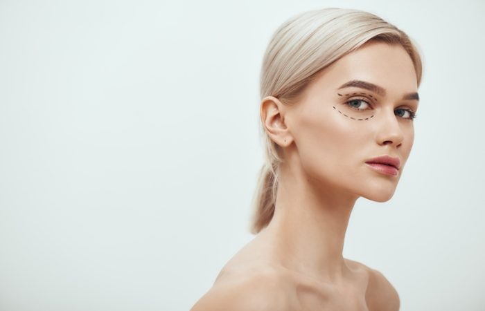 Tratamientos estéticos para párpados caídos: una joven mujer de piel muy blanca y ojos claros mira a la cámara. En su rostro hay líneas negras dibujadas por el cirujano estético que realizará un procedimiento para mejorar sus párpados