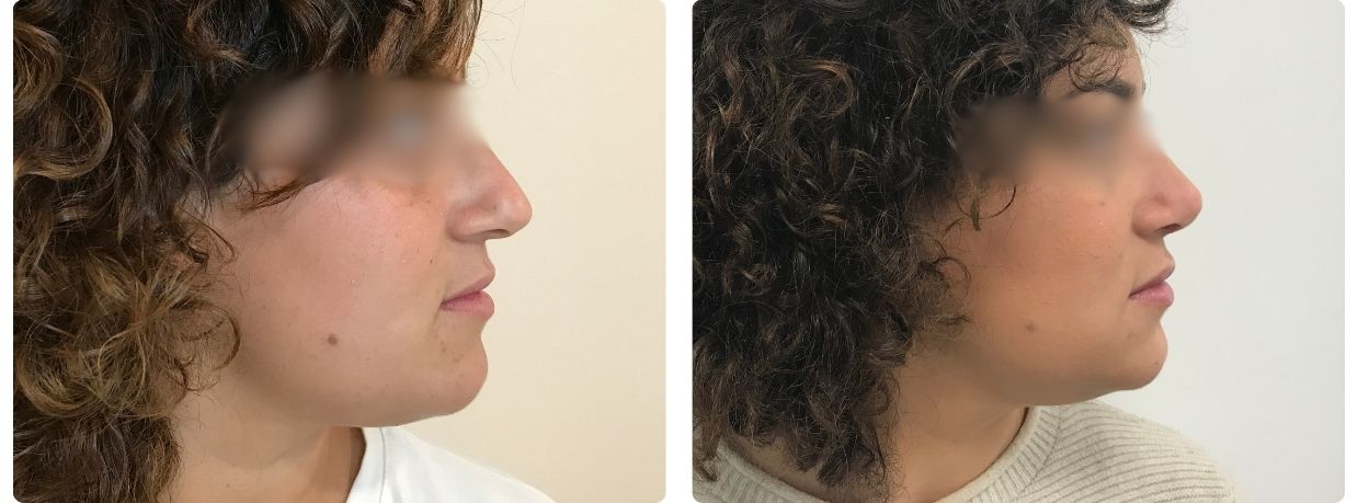 Rinoplastia Cadiz