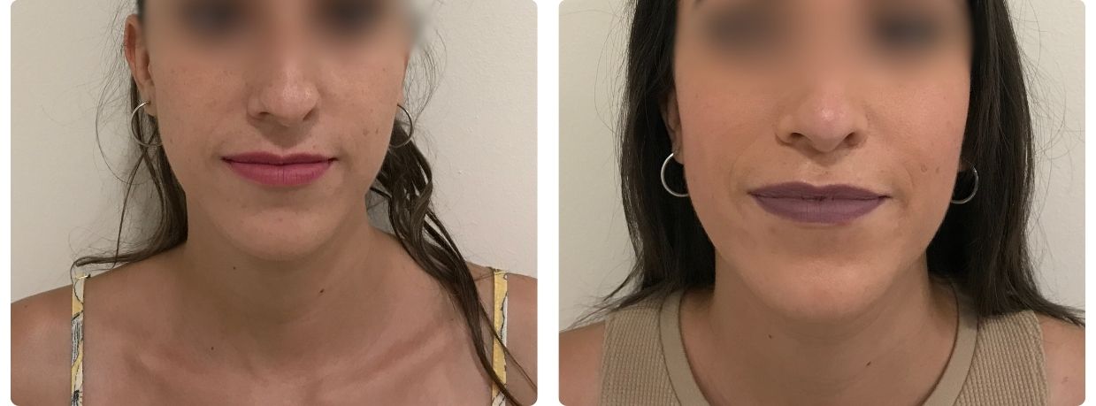 Rinoplastia Cadiz