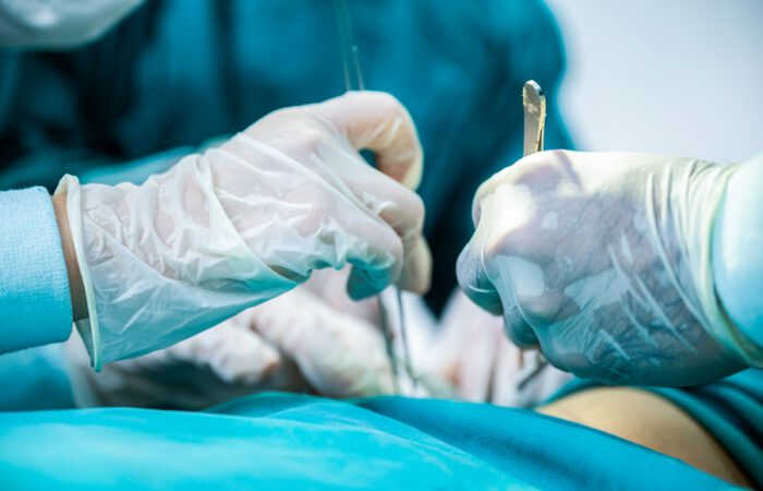 La cirugía plástica para quemaduras desempeña un papel crucial en la recuperación de pacientes que han sufrido este tipo de lesiones graves en la piel.