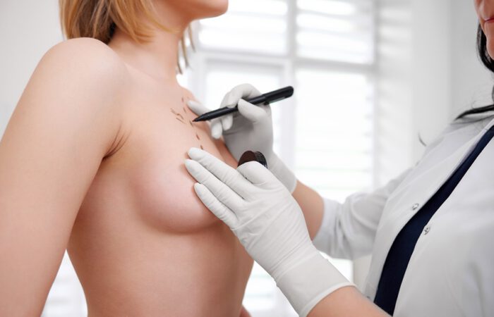 La mamoplastia híbrida es una técnica de aumento mamario que combina implantes con la transferencia de grasa propia.