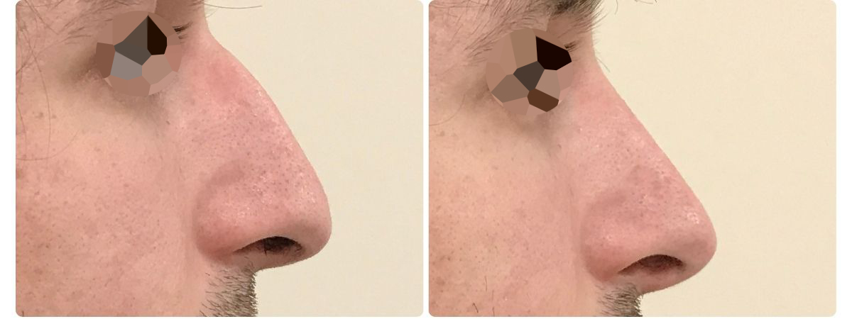 Diseño sin título - Resultados de la rinoplastia
