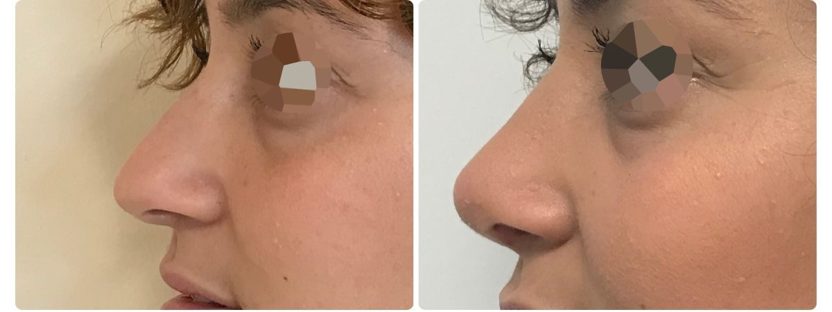Diseño sin título - Resultados de la rinoplastia