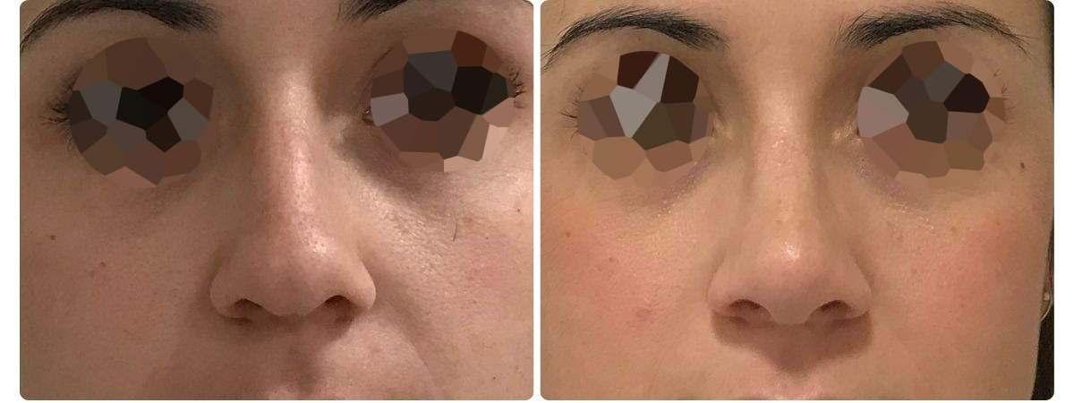 Diseño sin título - Resultados de la rinoplastia