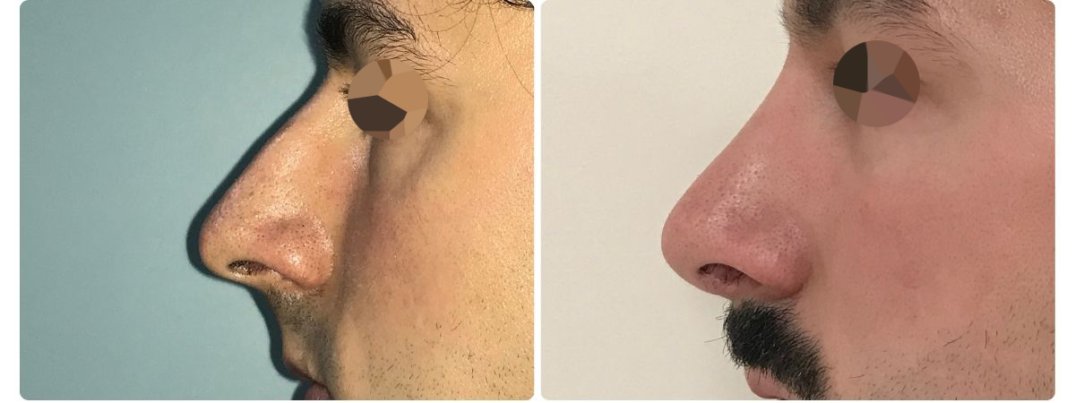 Diseño sin título - Resultados de la rinoplastia