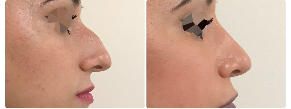 Diseño sin título - Resultados de la rinoplastia