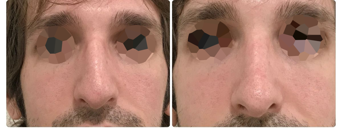 Diseño sin título - Resultados de la rinoplastia españa