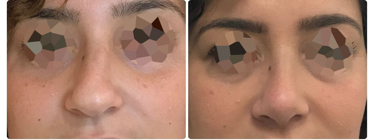 Diseño sin título - Resultados de la rinoplastia españa