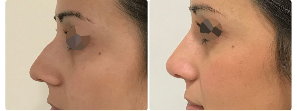 Diseño sin título - Resultados de la rinoplastia españa