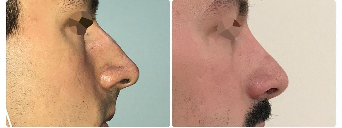 Diseño sin título - Resultados de la rinoplastia españa