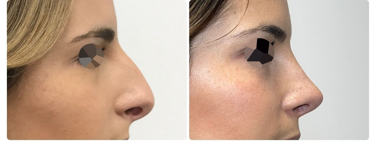 Diseño sin título - Resultados de la rinoplastia españa