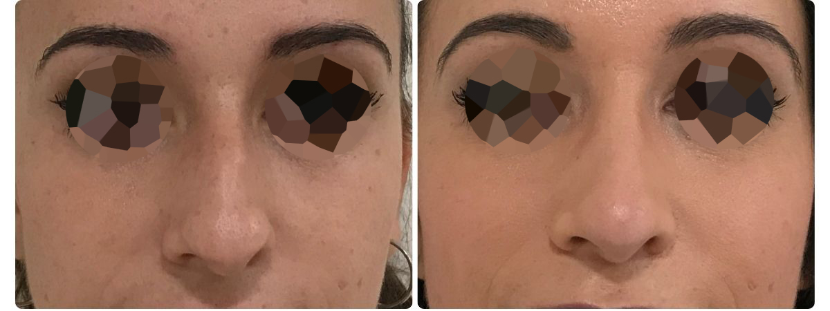 Diseño sin título - Resultados de la rinoplastia españa