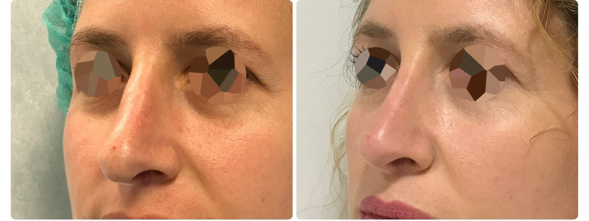 Diseño sin título - Resultados de la rinoplastia españa
