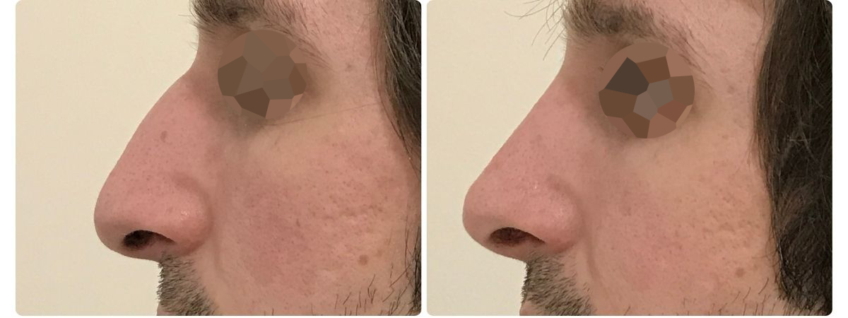 Diseño sin título - Resultados de la rinoplastia sevilla