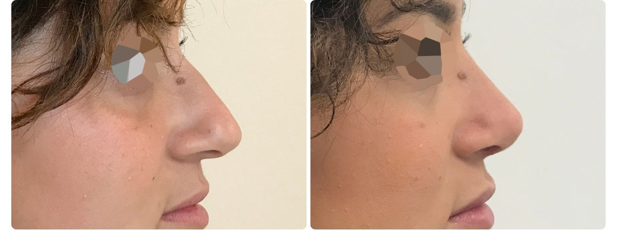Diseño sin título - Resultados de la rinoplastia sevilla