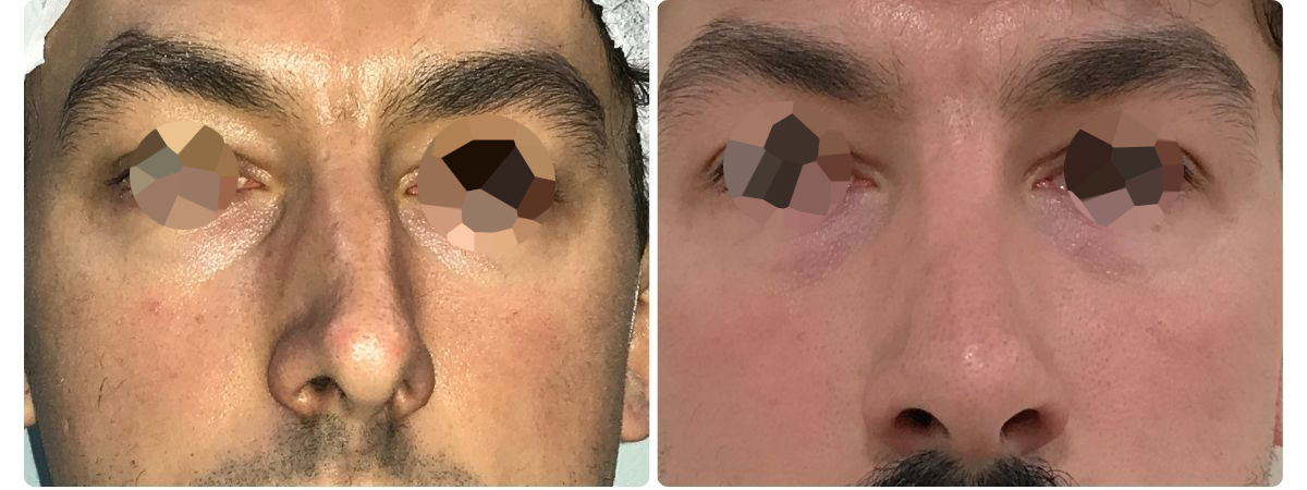 Diseño sin título - Resultados de la rinoplastia sevilla