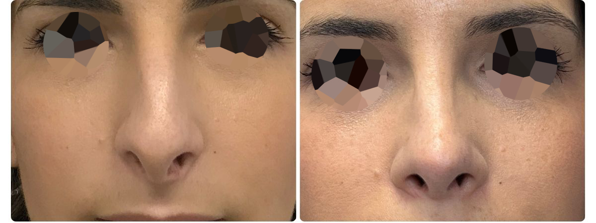 Diseño sin título - Resultados de la rinoplastia sevilla