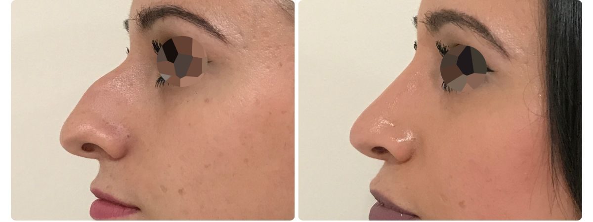 Diseño sin título - Resultados de la rinoplastia sevilla