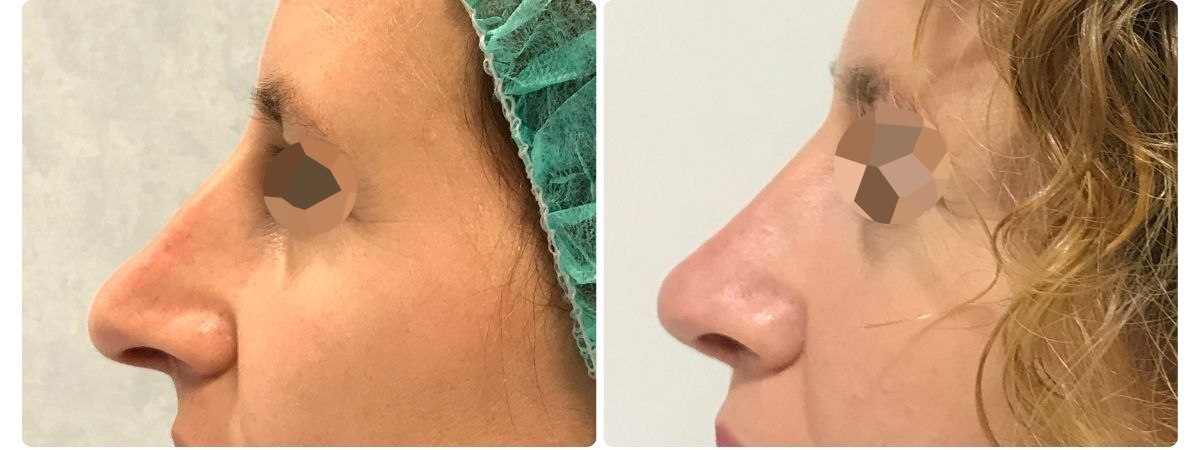 Diseño sin título - Resultados de la rinoplastia sevilla