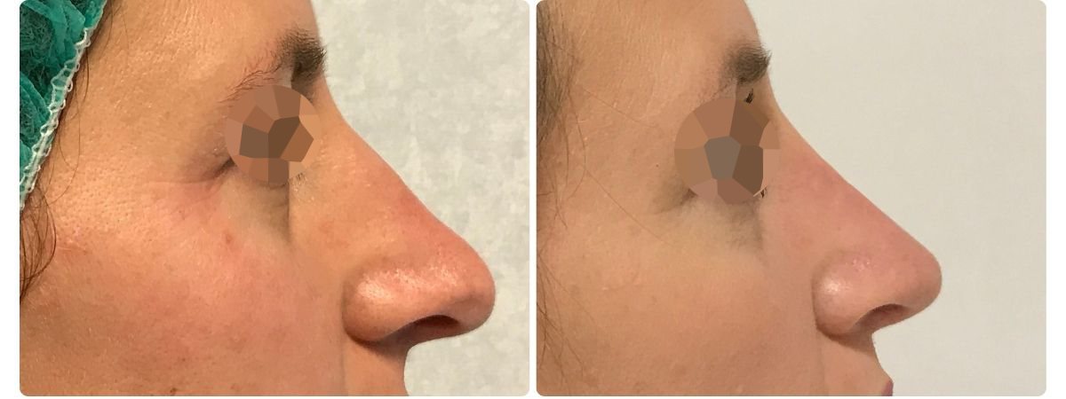 Diseño sin título - Resultados de la rinoplastia