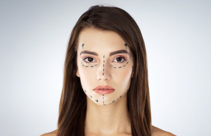 Representación de planificación de cirugía estética para procedimientos faciales combinados, con marcas faciales previas a la intervención quirúrgica.