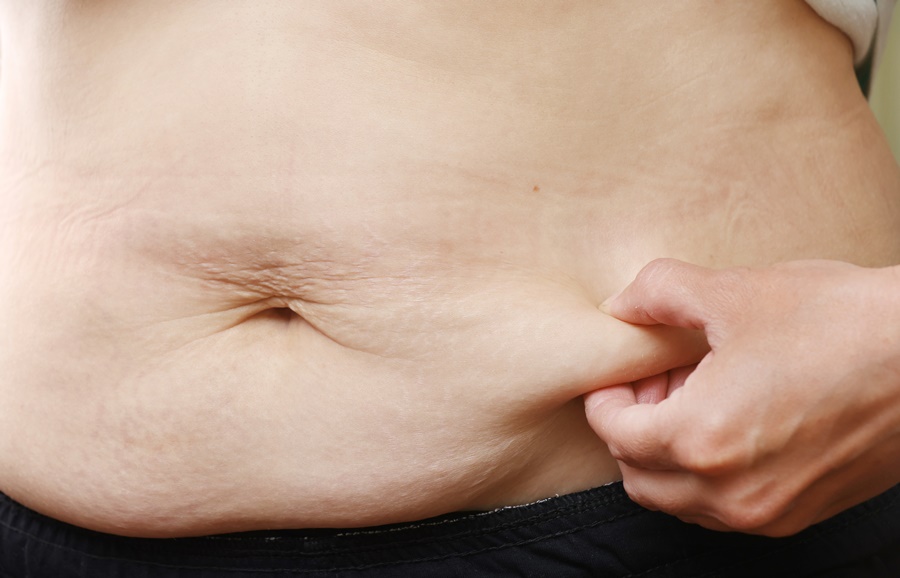Zona abdominal con exceso de piel antes de una dermolipectomía – cirugía estética.