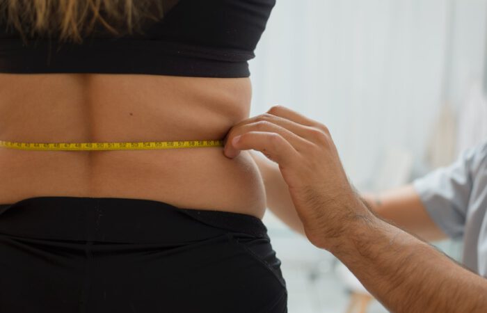 Evaluación del contorno abdominal en paciente con flacidez después de perder peso antes de cirugía estética corporal.