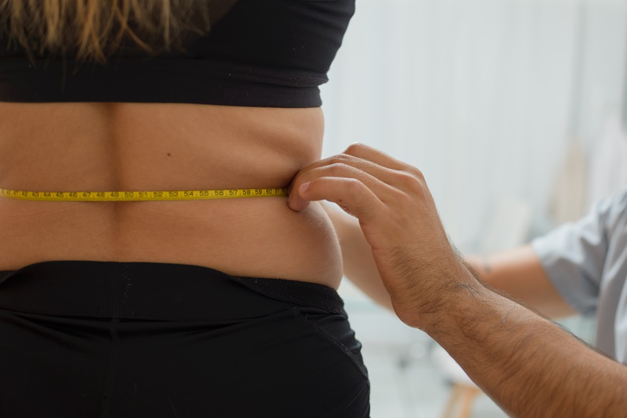 Evaluación del contorno abdominal en paciente con flacidez después de perder peso antes de cirugía estética corporal.