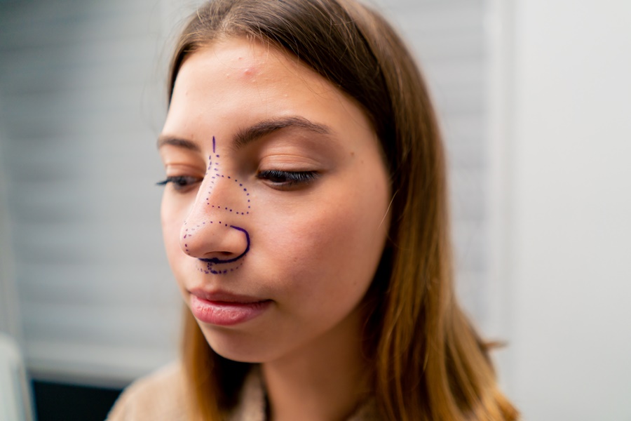 Paciente evaluada para rinoplastia estructural con planificación preoperatoria