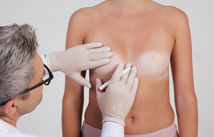 Cirujano plástico evaluando el pecho de una paciente para la corrección de pezones invertidos, marcando la zona a tratar con un rotulador médico.