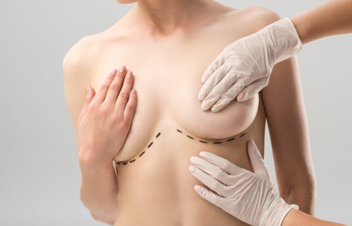 Mujer con asimetría mamaria durante valoración de cirugía plástica, mientras un especialista marca con guantes médicos las líneas de corrección en el busto.