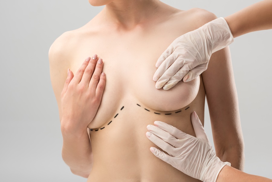 Mujer con asimetría mamaria durante valoración de cirugía plástica, mientras un especialista marca con guantes médicos las líneas de corrección en el busto.