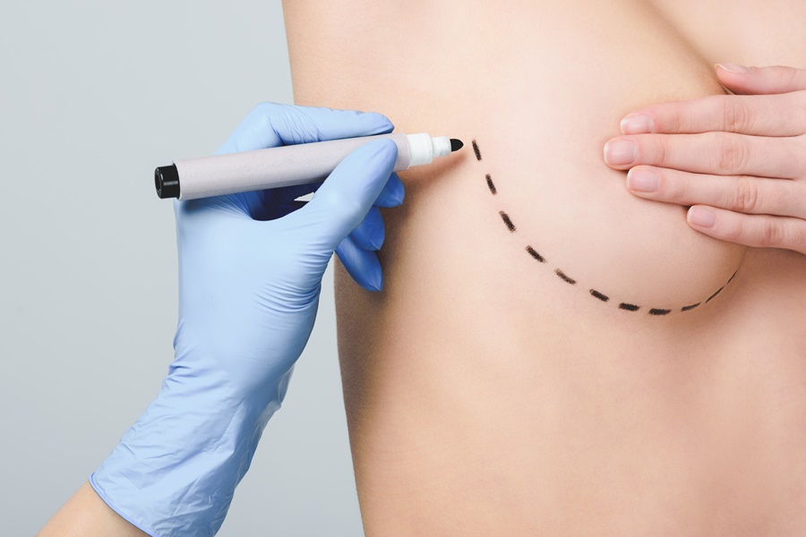 Detalle de asimetría mamaria con marcaje quirúrgico en el pecho de una paciente, realizado por un cirujano plástico para planificar la intervención estética.