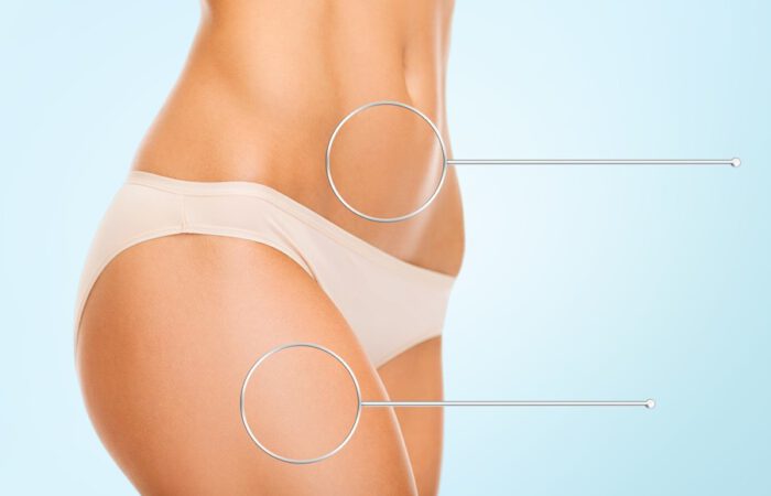 Cuerpo femenino de perfil con abdomen y muslo señalados con círculos, ilustrando zonas tratables mediante tecnologías de retracción cutánea tras lipoescultura.