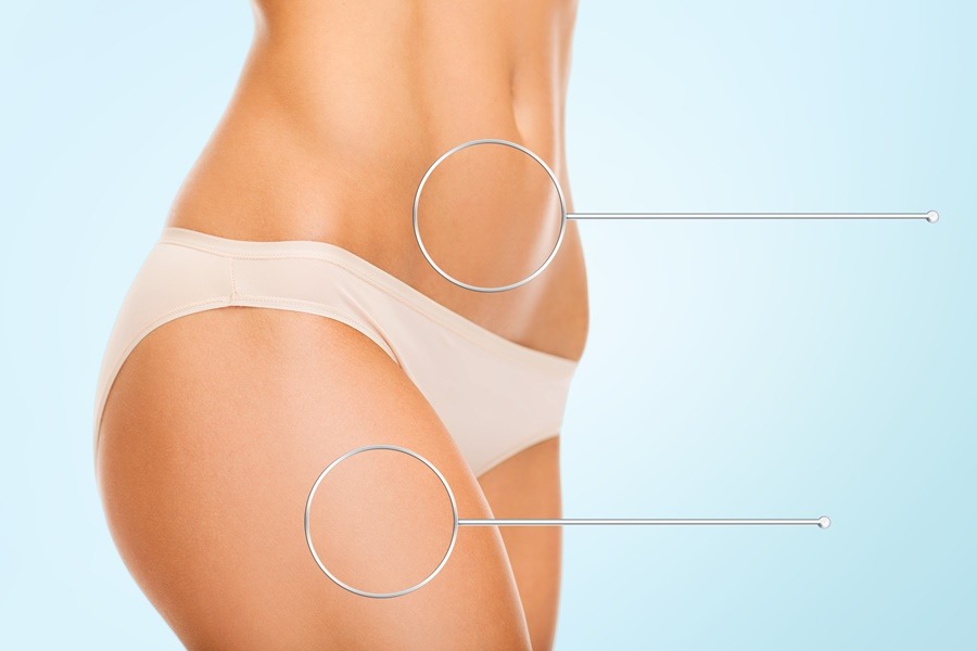 Cuerpo femenino de perfil con abdomen y muslo señalados con círculos, ilustrando zonas tratables mediante tecnologías de retracción cutánea tras lipoescultura.