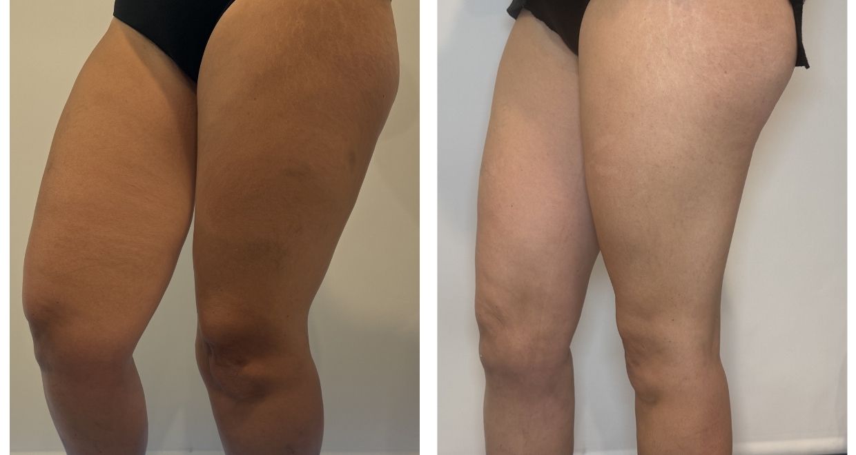 Antes y después Lipedema España - VIGO