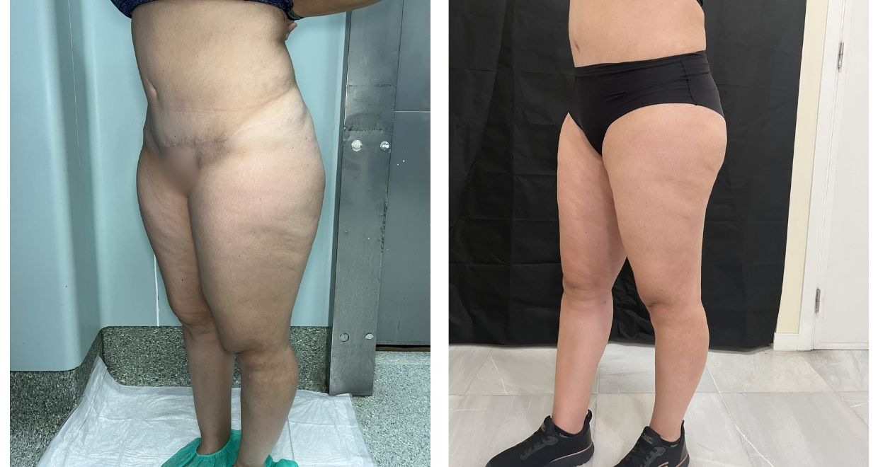 Antes y después Lipedema