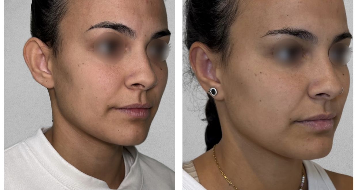 Antes y después Otoplastia España