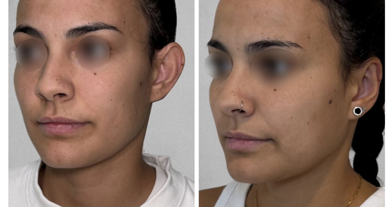 Antes y después Otoplastia
