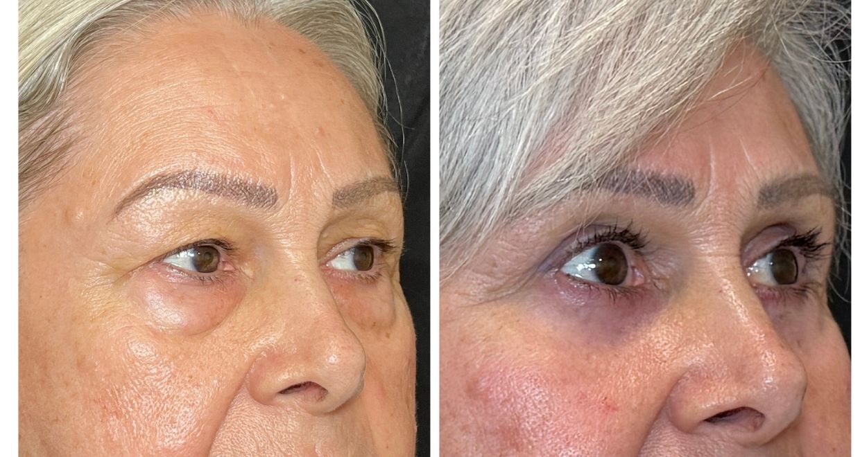 Antes y después - blefaroplastia